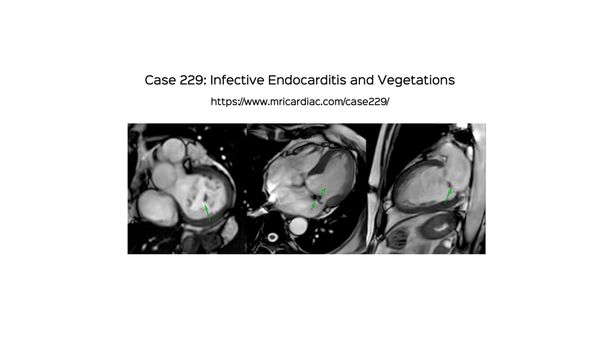 Case 229: Infective Endocarditis and Vegetations