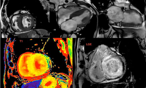 The Value of Extracellular Volume (ECV) in ATTR - Transthyretin Amyloidosis