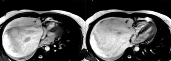 The Heart Under Siege !