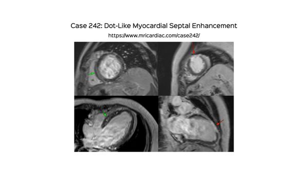 Case 242 - Dot-Like Myocardial Septal Enhancement