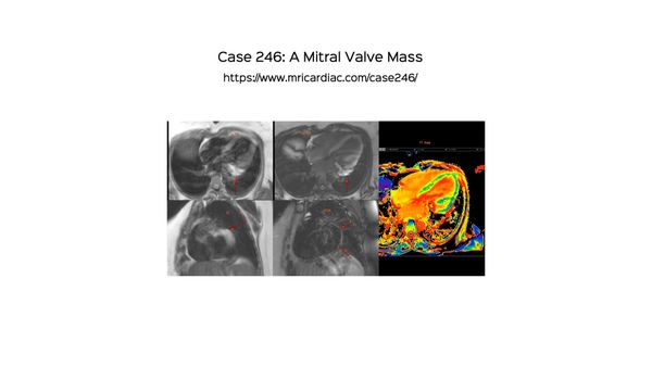 Case 246 - A Mitral Valve Mass