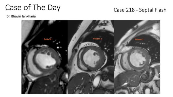 Case 260 - Septal Flash