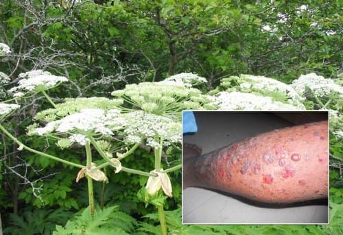 Giant hogweed on Island; contact burns, blisters skin