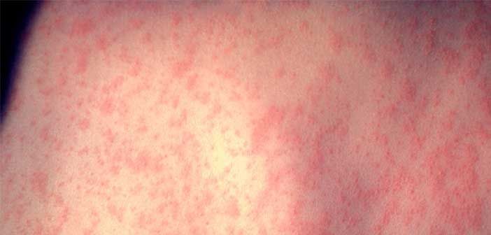 Measles outbreak hits Northern Ontario, public health officials urge immediate action