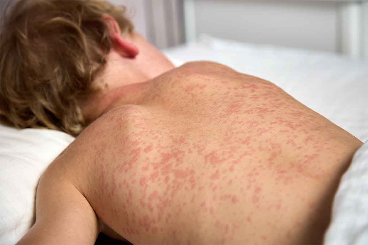 Toronto Public Health issues measles travel warning
