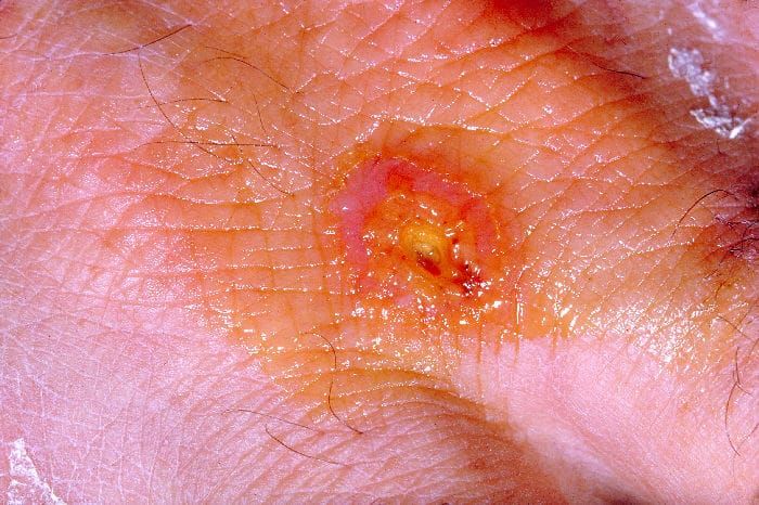 Confirmed case of tularemia reported by Sudbury & District Health Unit