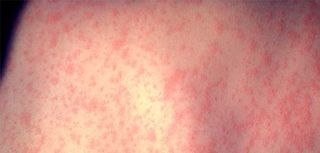 Measles outbreak hits Northern Ontario, public health officials urge immediate action