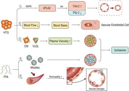 Artículo completo: Revisión exhaustiva sobre la patogenia de la  pancreatitis aguda asociada a hipertrigliceridemia