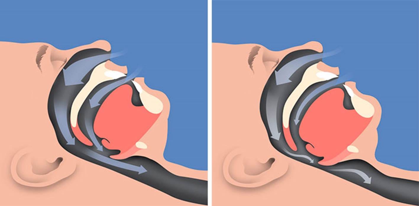 Apnea del sueño y ronquidos ◦ Causas y tratamiento dental