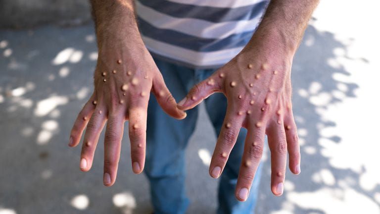 California Reports First Known Case of More Severe Mpox Strain in U.S.