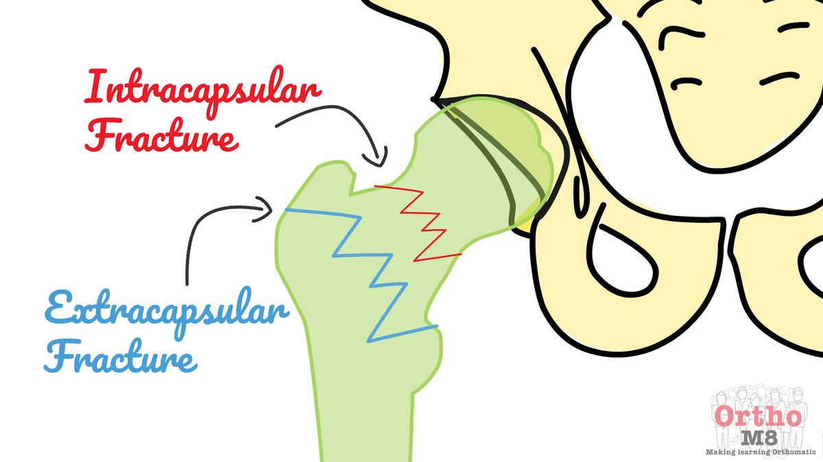 Classification of hip fractures