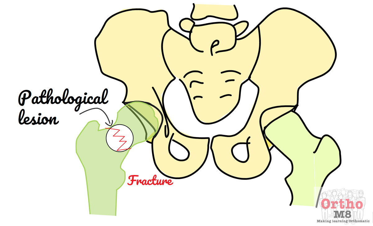 Pathological fractures of the hip