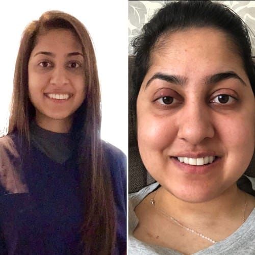 AI-Powered Health Apps Are Now Detecting 'Moon Face' Symptoms Before You Notice