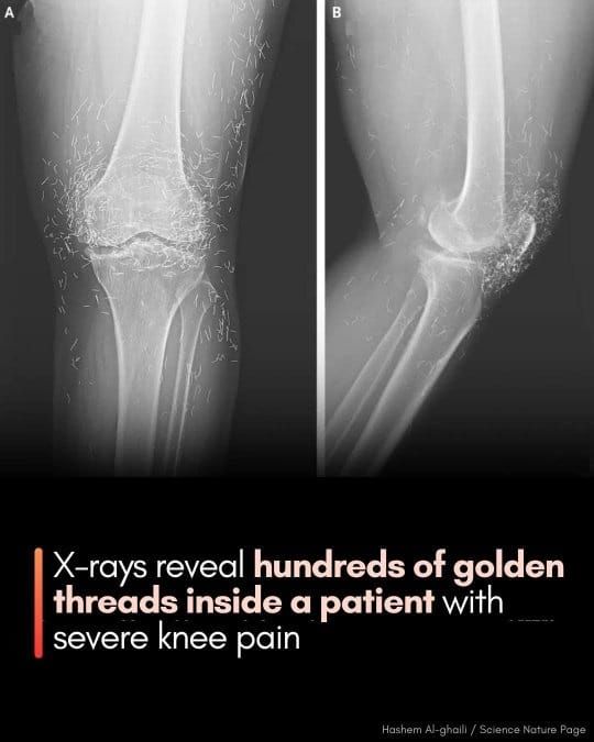 Hundreds of Gold Threads Found in Woman’s Knees After Acupuncture: A Shocking Case in South Korea