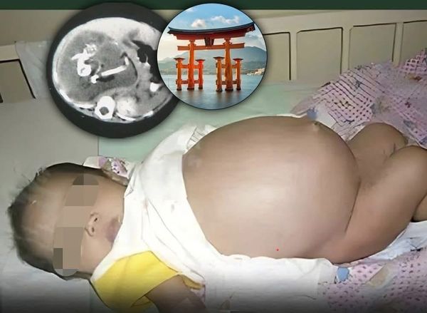 Baby Born with Her Own Twin Inside: Rare Medical Case in Hong Kong