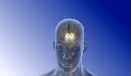 Depressed Man Feels Joy Again After 30 Years Thanks to Brain Stimulation Treatment