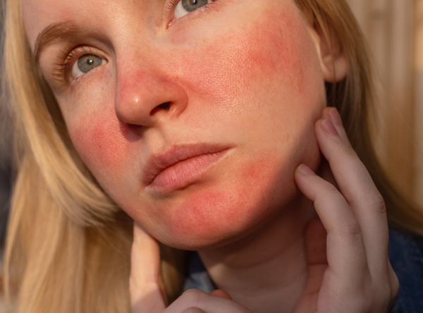 histamine intolerance foods to avoid