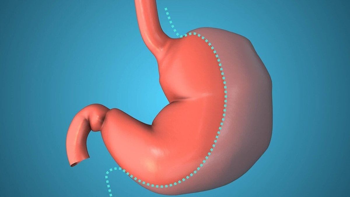 Duodenal switch vs. sleeve gastrectomy: What to know when deciding between weight loss surgeries