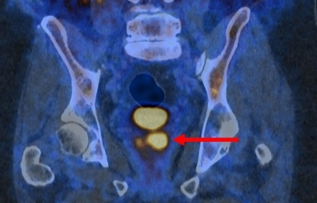 New state-of-the-art test identifies aggressive prostate cancer