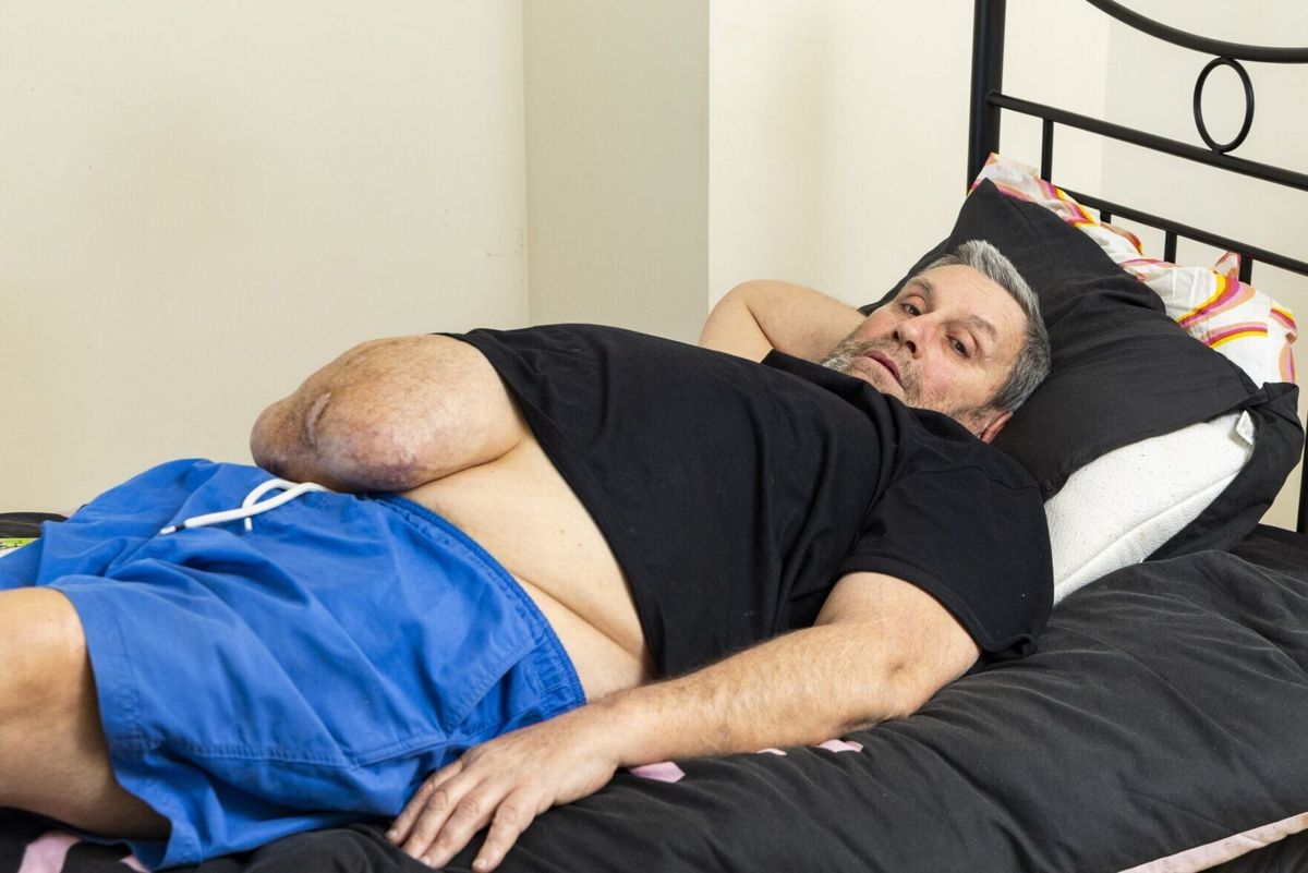Man fundraising for surgery to remove watermelon-sized mass