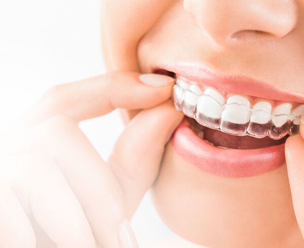 Invisalign Angel Clear Aligners Sandbach Cheshire Appointments Offered for Near-Invisible Teeth Straightening at Crown Bank Dental