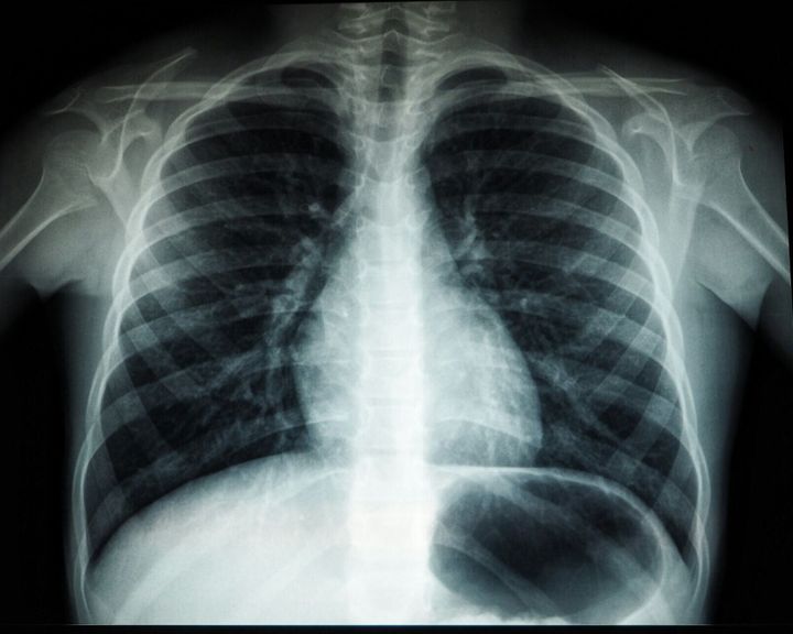 Test spots deadly bacterial infections in just 10 minutes