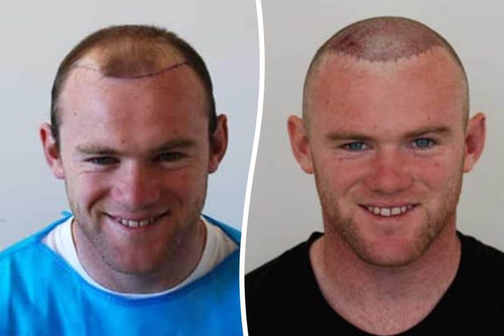 Clinic behind Wayne Rooney’s hair transplant gets 5 requests a day for the ‘Rooney’