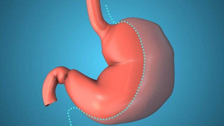 Duodenal switch vs. sleeve gastrectomy: What to know when deciding between weight loss surgeries