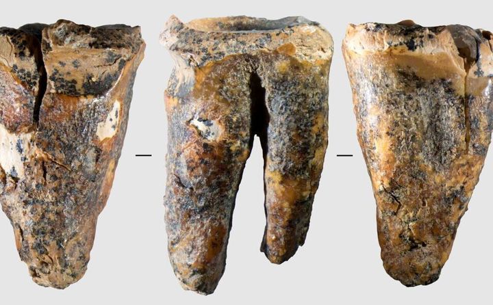 Tooth shows cavemen conducted dental surgery before anesthesia