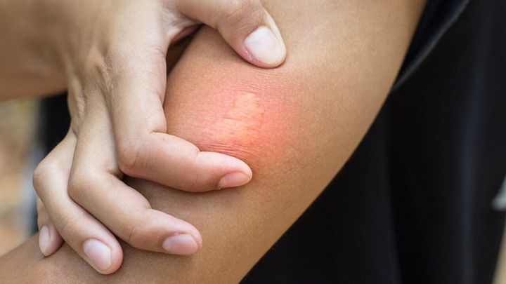 Normal bee sting vs. allergic reaction