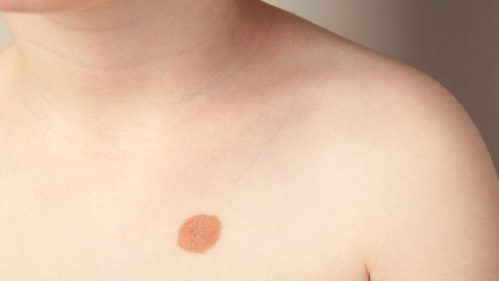 Moles vs. birthmarks: What's normal and what warrants a check