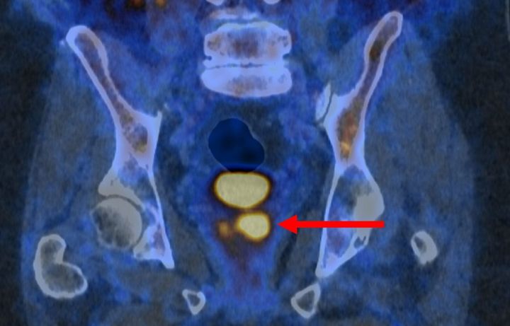 New state-of-the-art test identifies aggressive prostate cancer