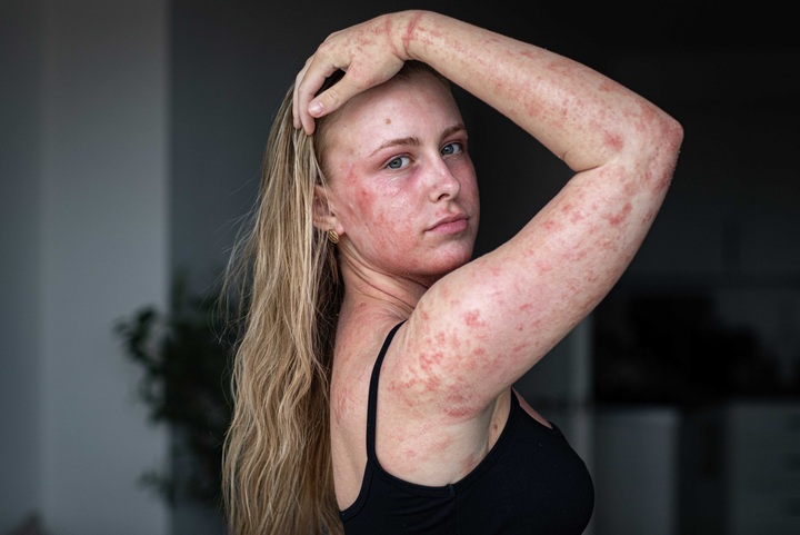 Woman left in agony after eczema cream leaves 95% of skin in pain