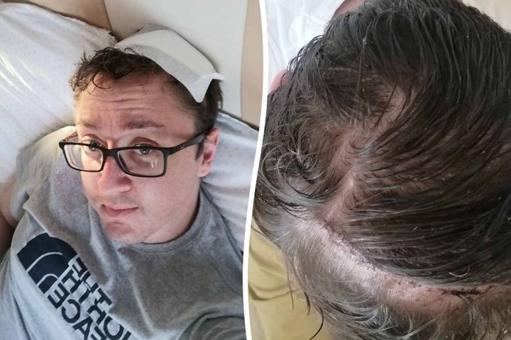 Man who thought headaches were due to stressful job had brain tumor