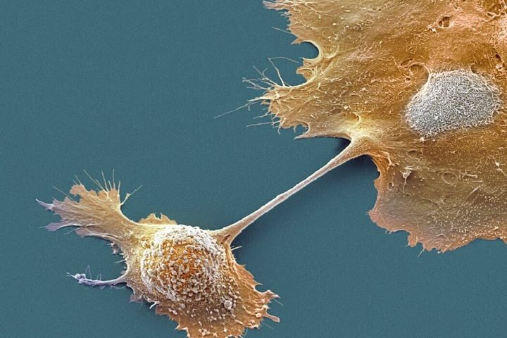Breakthrough drug nearly doubles survival with advanced pancreatic cancer – an oncologist explains how daraxonrasib overcame an ‘undruggable’ disease