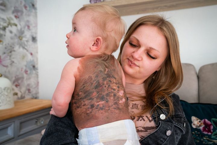 Family finds out baby’s ultra-rare birthmark is cancerous