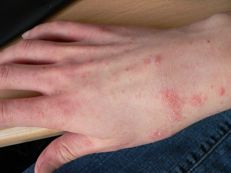 Once Rare, Scabies Is Now a Growing Problem in the Netherlands