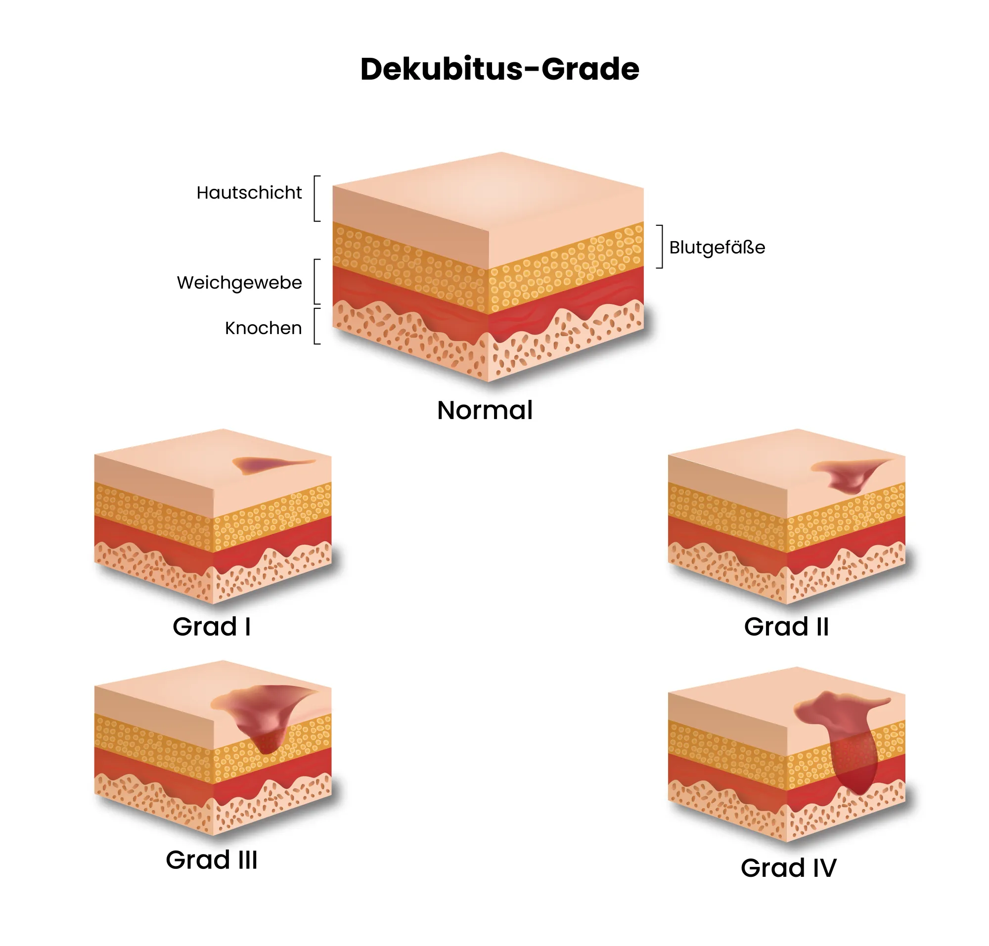 Medizinsiche Illustration der Dekubitus Grade
