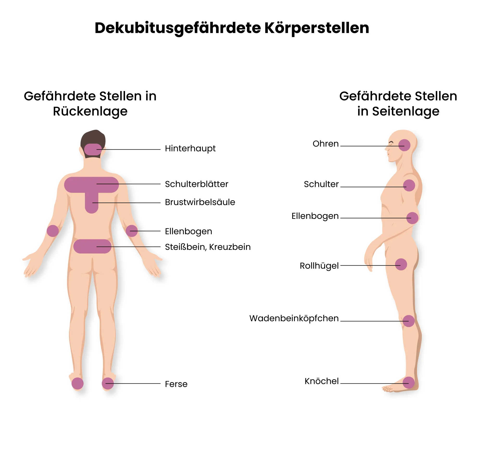 Illustaration der gefährdete Körperstellen für Druckgeschwüre (Dekubitus)