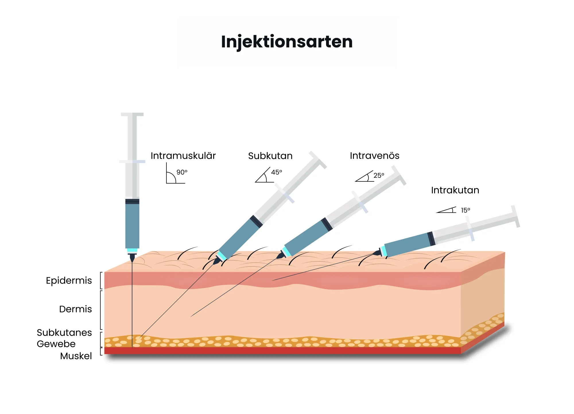 Medizinische Illustration unterschiedlicher Injektionsarten