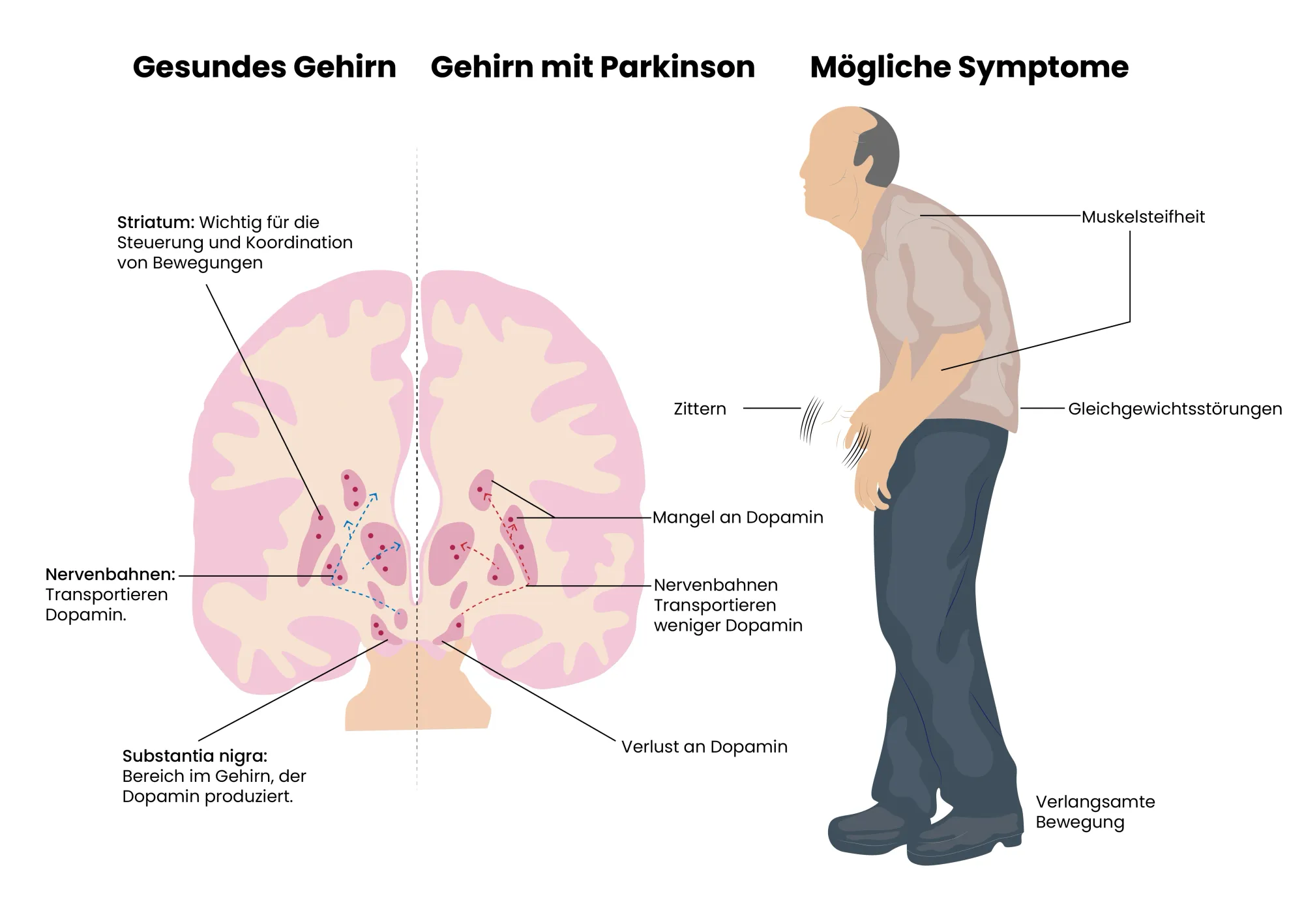 Abbildung der Auswirkungen von Parkinson auf das Gehirn und mögliche Syptome