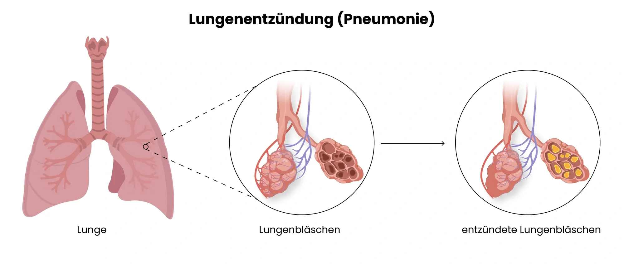 Es ist Pathophysiologie einer Lungenentzündung (Pneumonie) zu sehen.