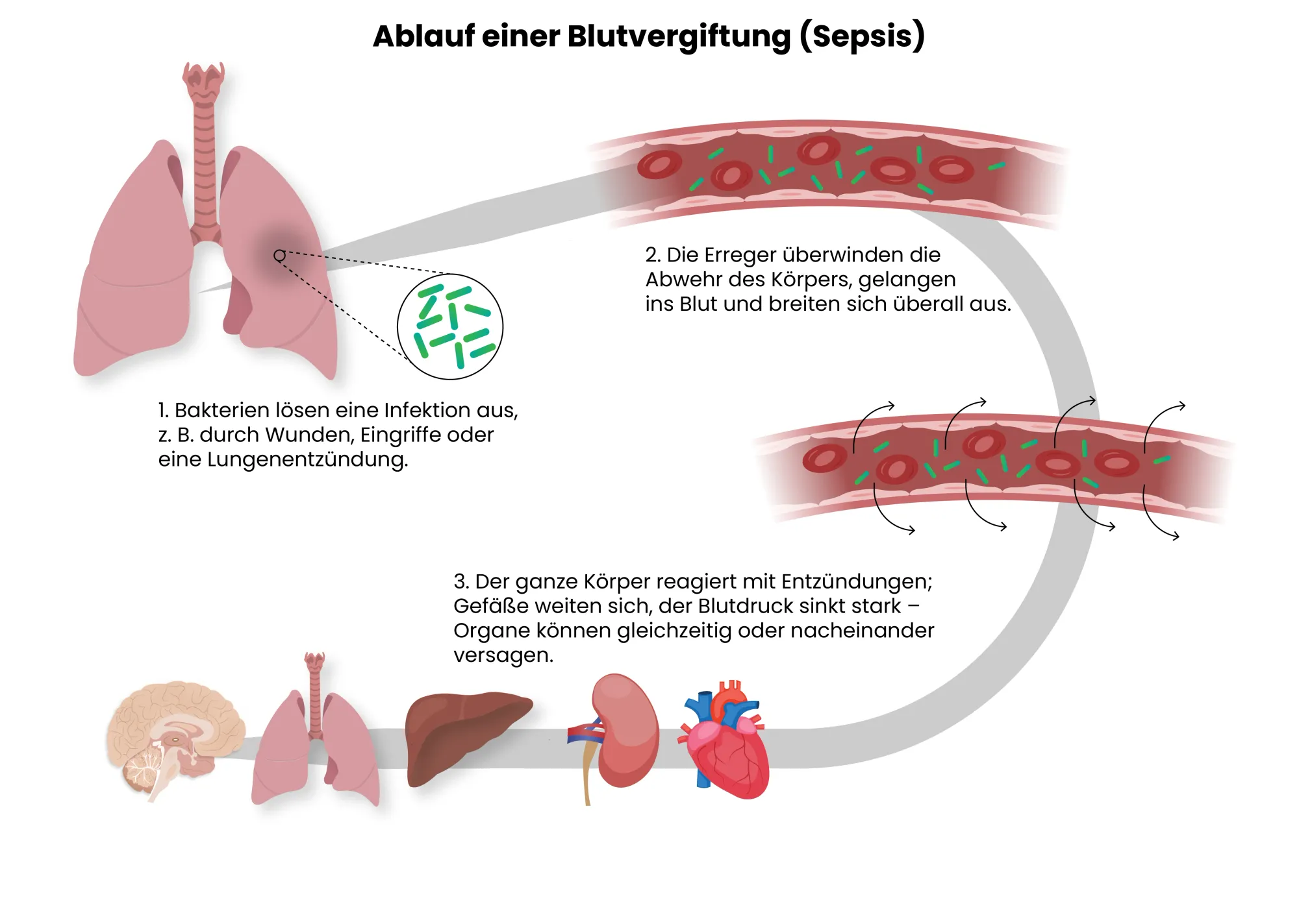  Medizinische Grafik des Ablaufs einer Blutvergiftung (Sepsis)