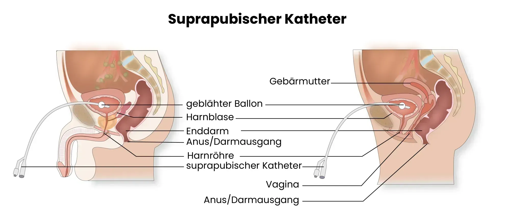 Medizinische Grafik eines suprapubischen Katheters