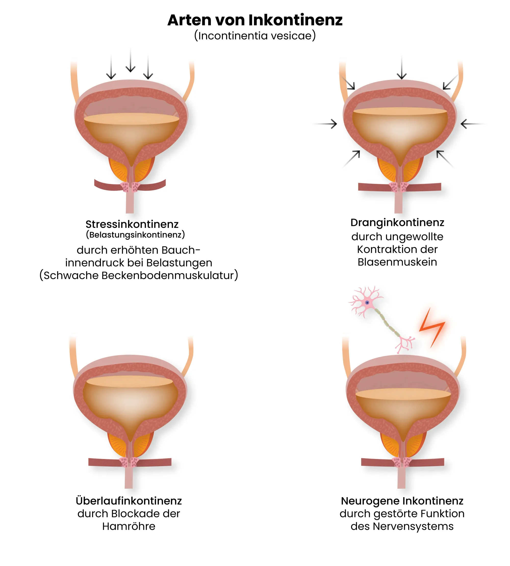 Medizinische Grafik der Arten von Inkontinenz
