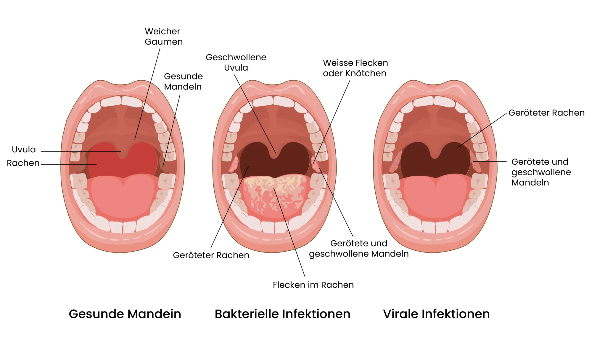 Medizinische Grafik einer bakteriellen und viralen Infektion