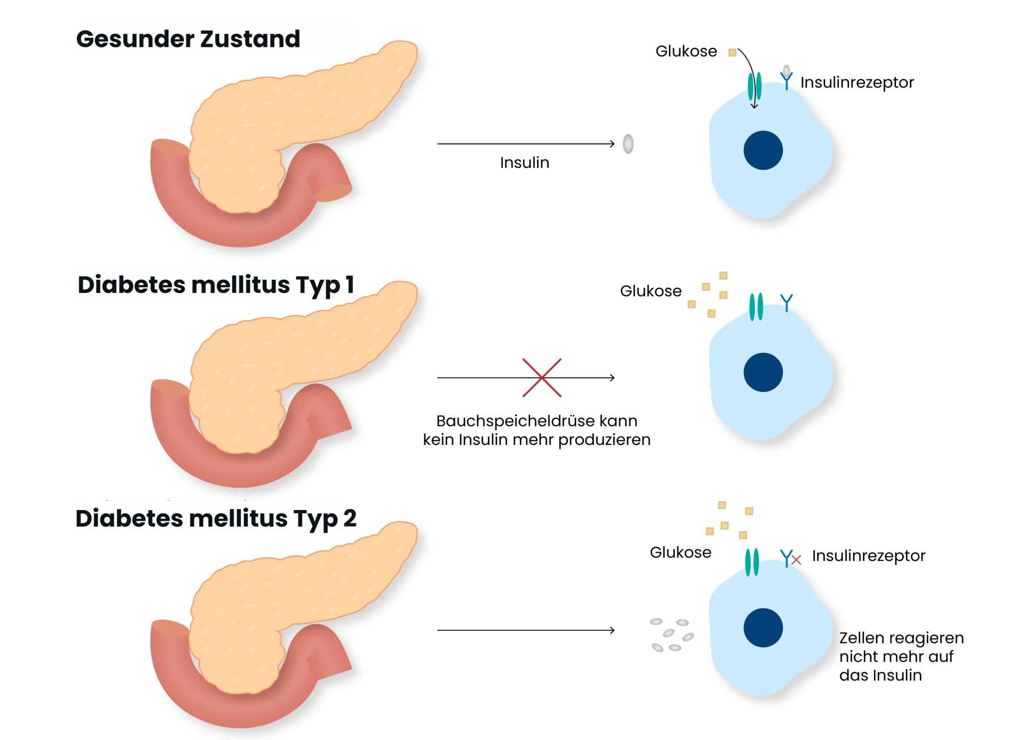 Medizinische Grafik von unterschiedlichen Diabetes Typen