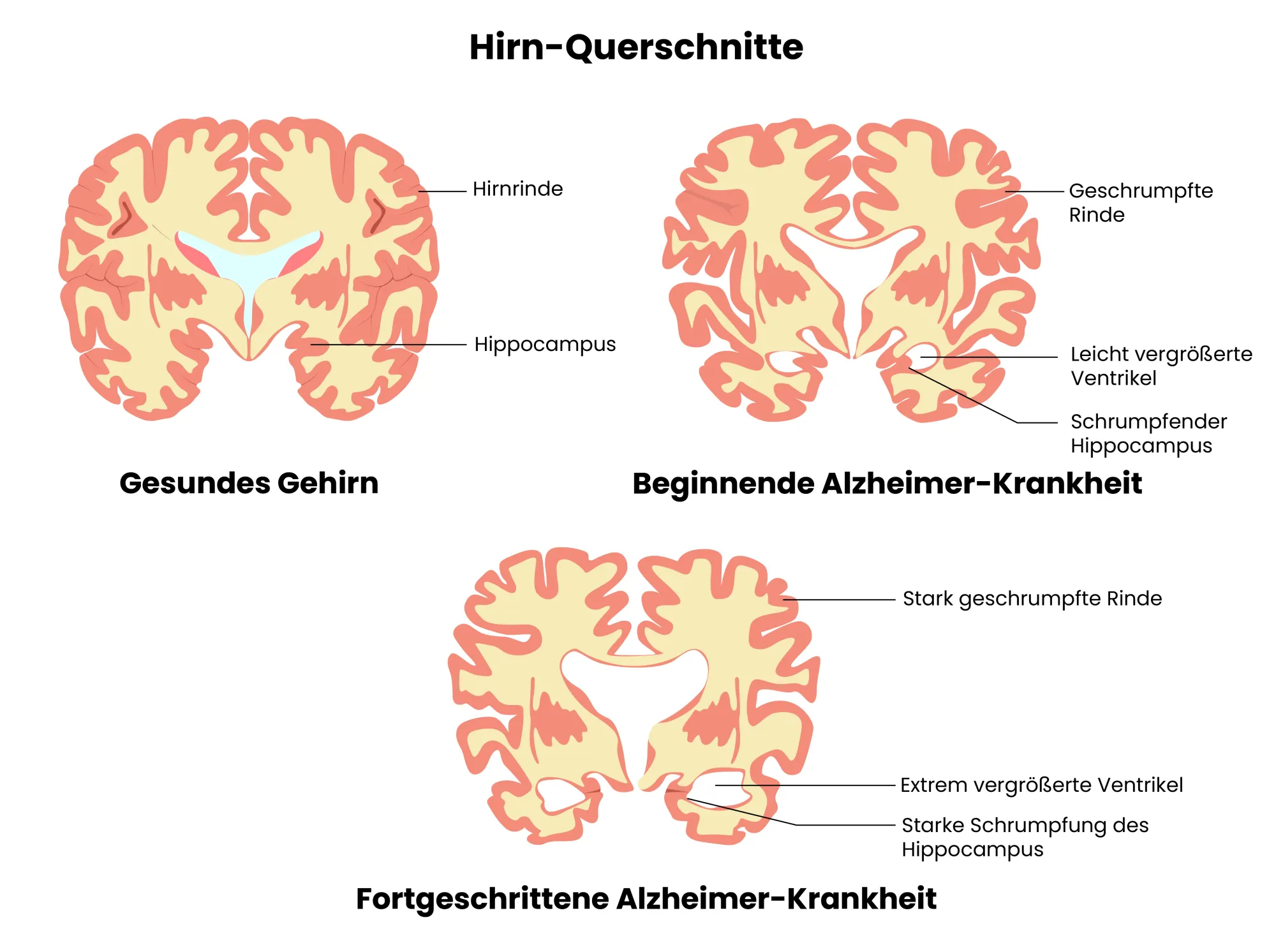 Medizinische Grafik von Hirn-Querschnitten von Alzheimer Stadien