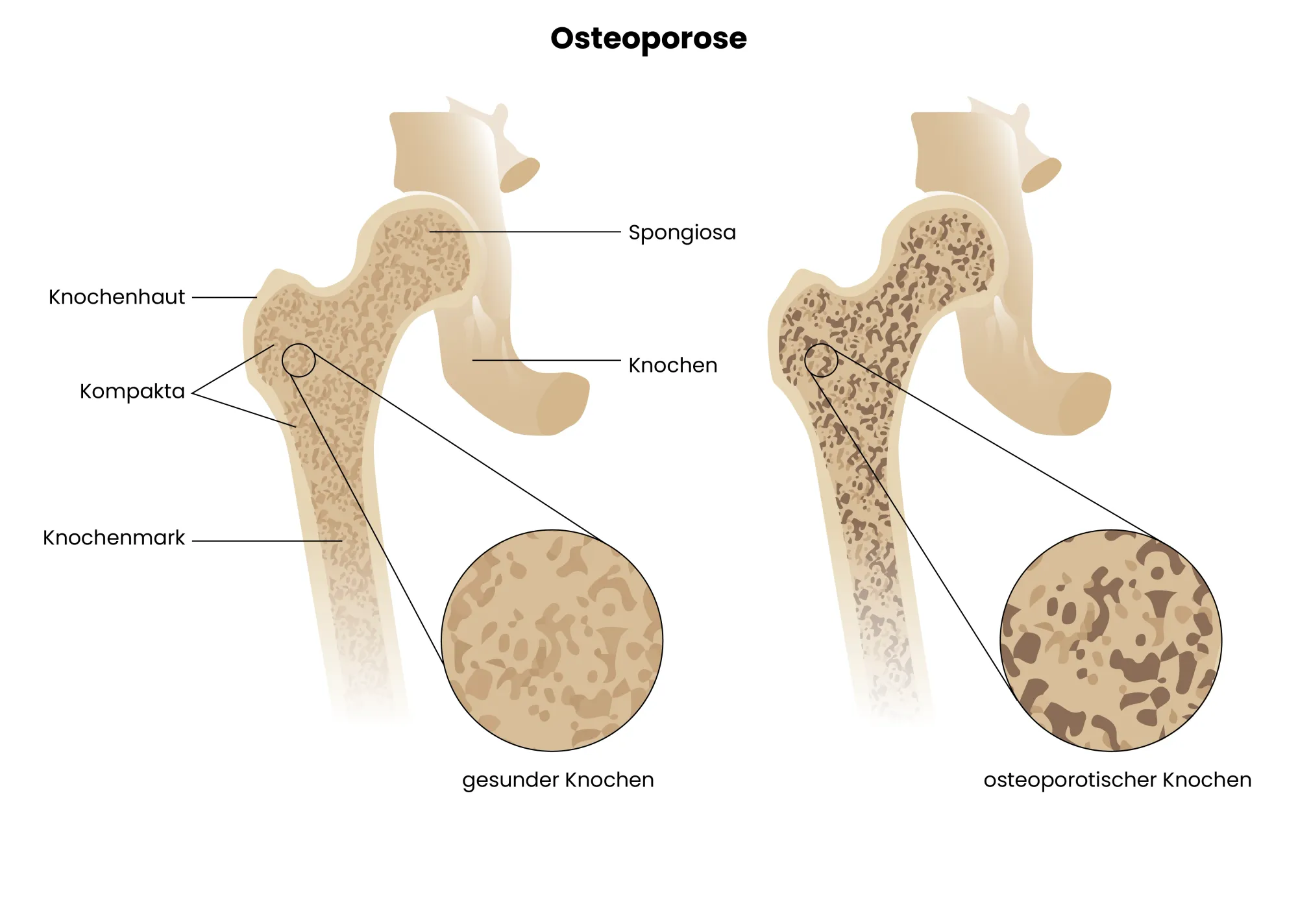 Medizinische Grafik der Osteoporose