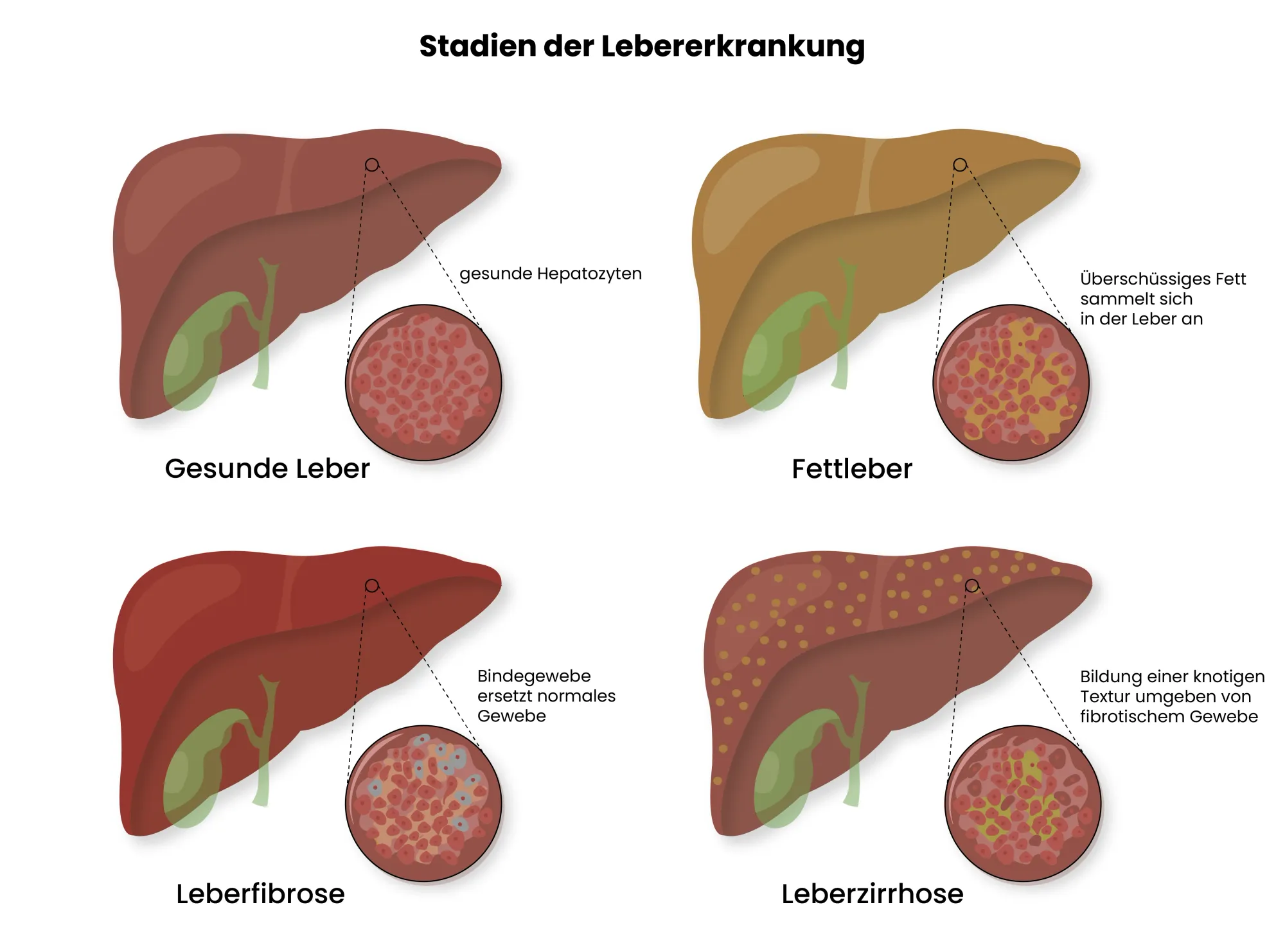 Medizinische Grafik von Stadien einer Lebererkankung